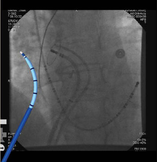 Диагностический катетер в полости сердца при внутрисердечном ЭФИ
