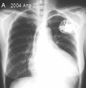 Рентгеновский снимок ДКМП c CRT первый день после имплантации