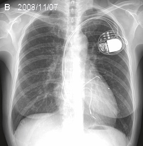 Рентгеновский снимок ДКМП с CRT  через четыре года 