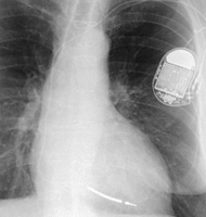 Рентгеновский снимок  с имплантированным кардиовертер-дефибриллятором